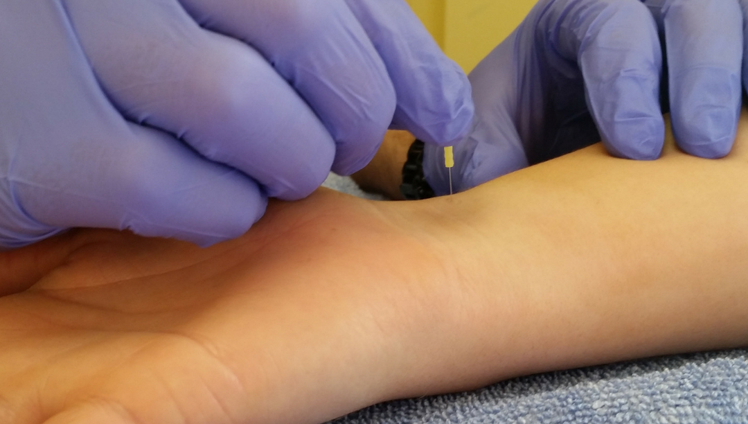 How Dry Needling Helps Relieve Pain
