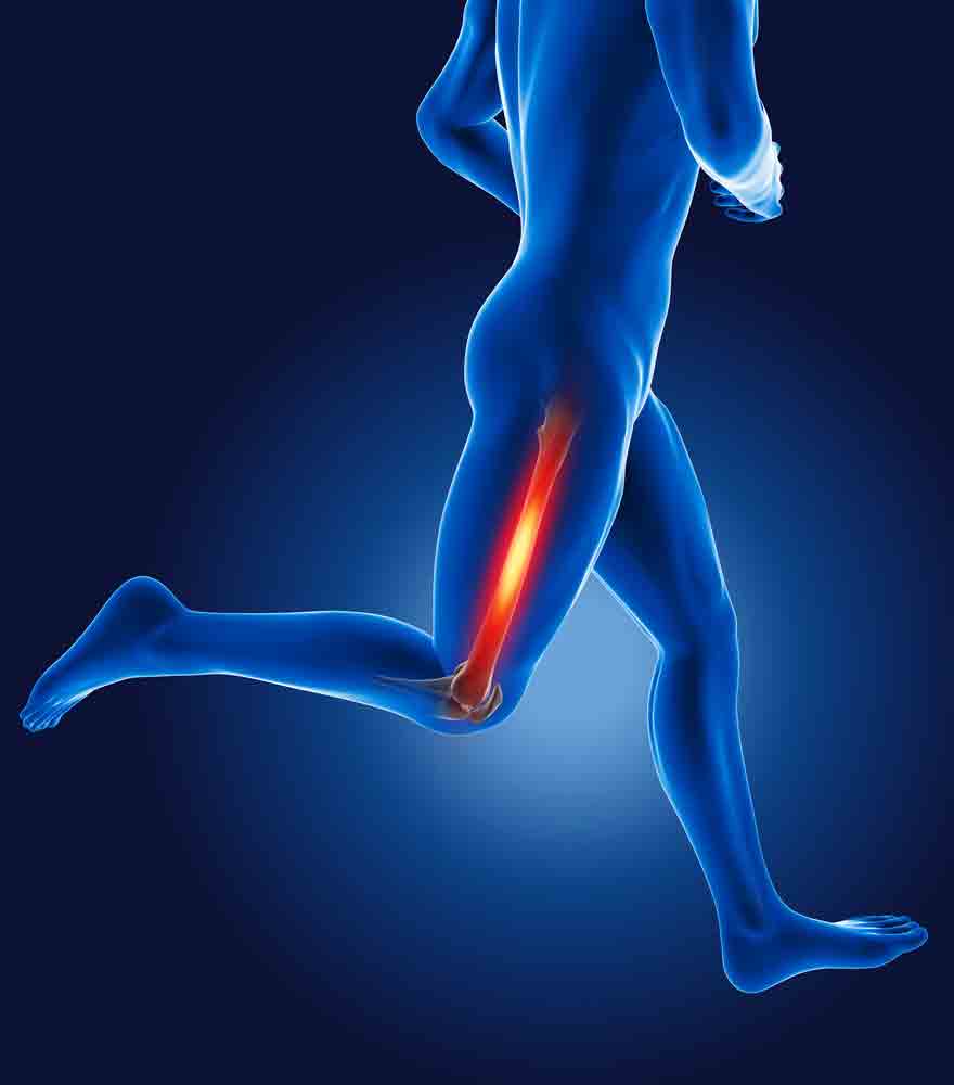 Managing IT Band Friction Syndrome running leg pain physical therapy oakland 128648288 1 managing it band friction syndrome hip pain