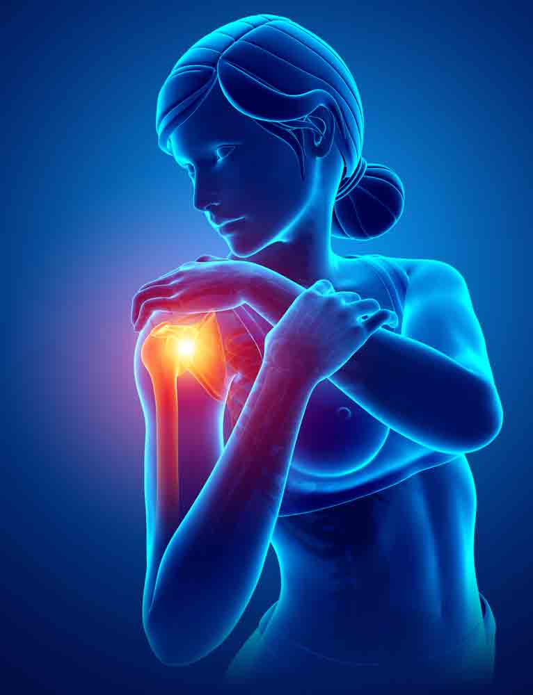 Understanding Shoulder Impingement Syndrome shoulder pain oakland physical therapy 598778627 1 understanding shoulder impingement syndrome shoulder pain