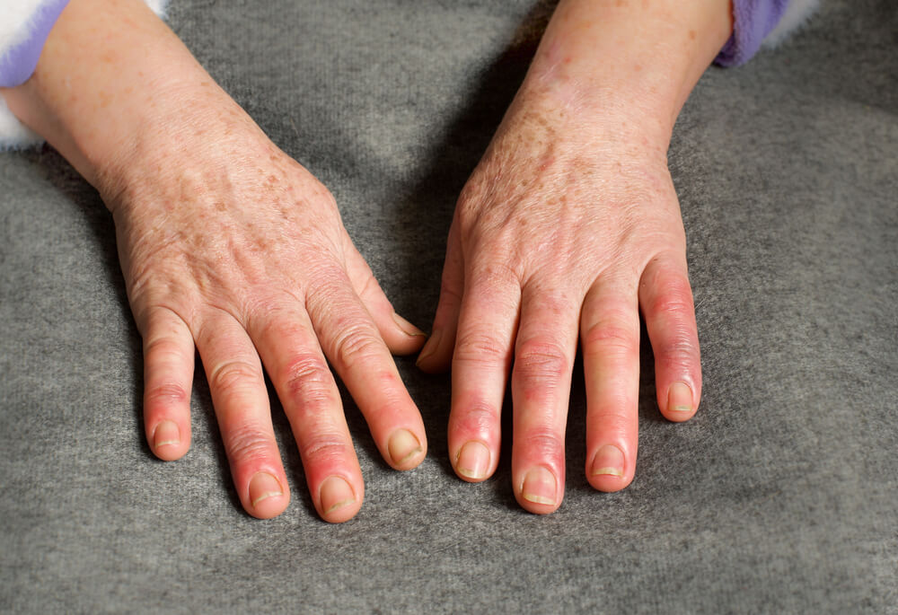 why are my fingers swollen